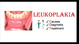 Leukoplakia  Causes Diagnosis amp Treatment [upl. by Lesser]