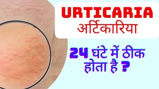 urticaria in hindi  urticaria treatment in hindi  hives on skin  urticaria symptoms [upl. by Henderson683]