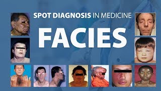 Abnormal Facies  Spot Diagnoses in Medicine [upl. by Jeb327]