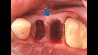 Implantes post extracción contiguos con RTG [upl. by Ahseyt162]