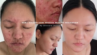 How I cleared acne rosacea without medication  Skincare storytime amp simple routine [upl. by Naivaf]