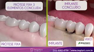 DIFERENÇAS ENTRE IMPLANTE DENTÁRIO E PRÓTESE FIXA ImplArtImplanteseestetica [upl. by Nord]