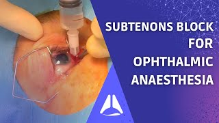 Subtenons block regional anaesthesia for ophthalmic surgery Live patient UPDATE [upl. by Juliet]