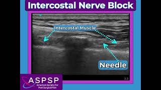 Intercostal Nerve Block [upl. by Lashonda]