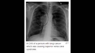 Superior Vena Cava Syndrome [upl. by Aihsila]