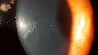 Vogts Striae in Keratoconus [upl. by Eigram537]