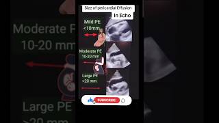 Size Pericardial effusion echo ultrasound babyviralvideo trending baby [upl. by Gnouhc351]