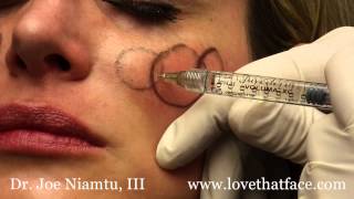 Juverderm Voluma 5 Minute Cheeks by Dr Joe Niamtu III [upl. by Kwon]