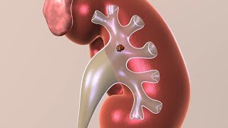 Kidney Stone Treatments [upl. by Jerrylee]