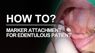 Marker attachment for edentulous condition DIOnavi Learning Contents [upl. by Aseiram]