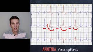 Bigeminismo ventricular [upl. by Treblah62]