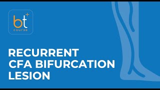 Course Preview Endovascular Treatment of a Recurrent CFA Bifurcation Lesion [upl. by Ahsitneuq]