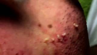 Acne Solution  Blackheads amp Whiteheads Removal 1  How to get rid of acne [upl. by Bocaj803]