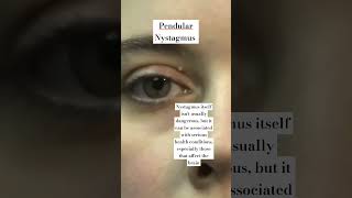 Involuntary movement of Eye Pendular Nystagmus shorts ytshortindia viral optometry doctor [upl. by Perrins]