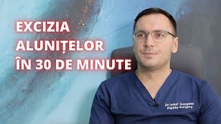 Excizia alunitei în 30 de minute  DermaBeauty Clinique [upl. by Jeanie25]