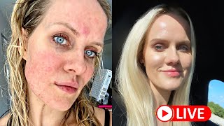 How I cured my ROSACEA naturally [upl. by Rivard]