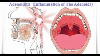 ADENOIDITIS Definition of adenoiditis Causes of adenoiditis Symptoms of adenoiditis✨ [upl. by Otrebilif75]