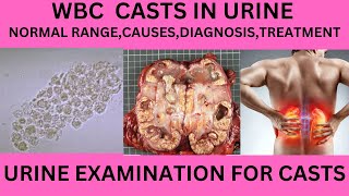 WBC CAST IN THE URINE CAUSES SYMPTOMS AND TREATMENT OF WBC CAST IN URINE EXAMINATIONURINE ROUTINE [upl. by Esadnac]