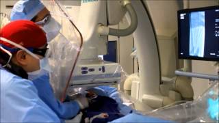 Atherectomy for PAD at Mount Sinai NYC [upl. by Koran494]