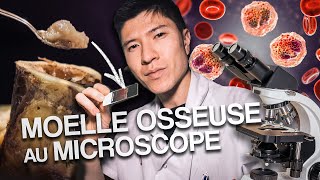 On observe une leucémie au microscope [upl. by Haukom]