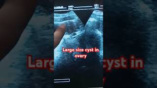 Largest cyst in ovaryshortyoutubevideo pregancyultrasound pregnant [upl. by Ailido]