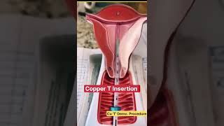 IUD Insertion  Copper T Insertion  Copper T Procedure iud gynocology vaginamedical shrts [upl. by Ultan]