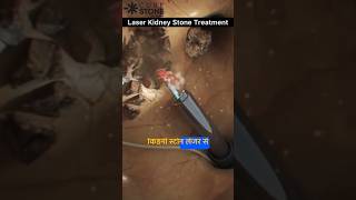 Kidney stone removal  Kidney stone treatment  laser treatment  Rirs  shorts curestone [upl. by Colleen]