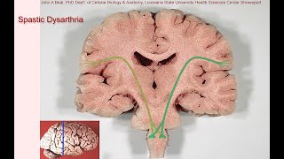 Spastic dysarthria  samples and tutorial [upl. by Annahsed60]