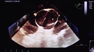 Unicuspid aortic valve with severe AR [upl. by Rafi]