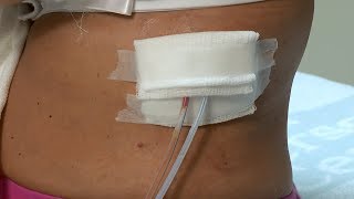 How to care for a postsurgery wound drainage system and gauze dressing [upl. by Siuraj609]