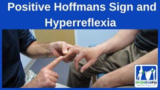 Positive Hoffmans Sign and Hyperreflexia [upl. by Nigrom]