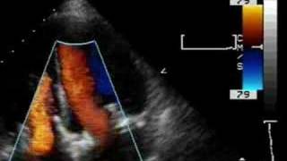 Prosthetic tricuspid valve and mitral valve [upl. by Annaet782]