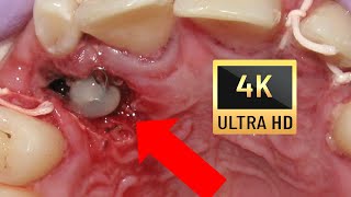 🤔HOW BRACES WORK Amazing Impacted Canines  Explained💖 in 4K 7Year Followup❗💚 [upl. by Sanborne]