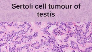 Sertoli Cell Tumour of the Testis  Pathology mini tutorial [upl. by Biamonte]