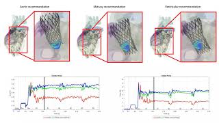 LHHM CoreValve [upl. by Dorkas]