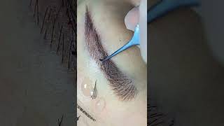 eyebrow transplantation eyebrow sopracciglio sobrancrlhas cejas sourcils hairtransplantation [upl. by Ahseekat]