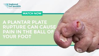 A Plantar Plate Rupture Can Cause Pain in the Ball of Your Foot [upl. by Bertle]