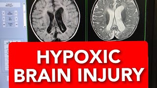 MRI of Hypoxic Ischaemic Brain Injury 10months Child shorts shortsvideo shortsvideos [upl. by Luap]