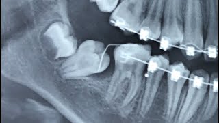 Disimpacting Molars Using The Bach Technique [upl. by Diraf142]