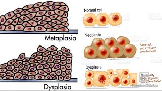 Metaplasia and dysplasia 😀 [upl. by Anuska]