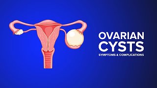 Ovarian Cysts  Symptoms and Complications Explained by an OBGYN [upl. by Ennairb]