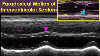 What is Paradoxical Motion of Interventricular Septum [upl. by Aseneg456]