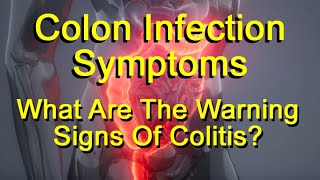 Colon Infection Symptoms  What Are The Warning Signs Of Colitis [upl. by Idac]