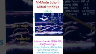 MMode Echo in Mitral Stenosis [upl. by Leimad]