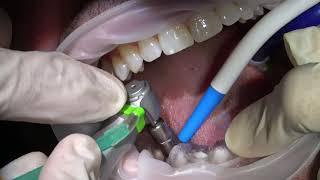 immidiate implant placement and loading [upl. by Oribel]