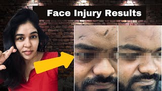 Injury scar on face treatment by lasers and surgery 9999 747 717 [upl. by Avrenim]