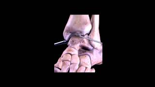 Artroscopia de tobillo pinzamiento Ankle arthroscopy impingement [upl. by Ellison]