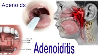 Adenoiditis  Adenoids  Symptoms Causes Complications Diagnosis and Treatment [upl. by Ralston]