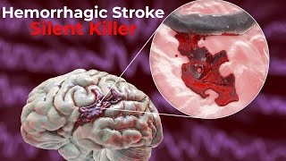 Hemorrhagic Stroke  causes symptoms diagnosis treatment pathology [upl. by Elonore]