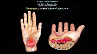 Carpal Tunnel Injection Is injection helpful [upl. by Ecidnacal722]